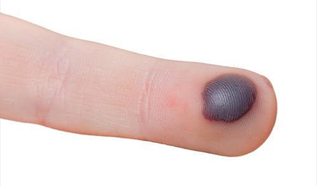 بثور الدم.. إحذر إذا ظهرت في الفم!