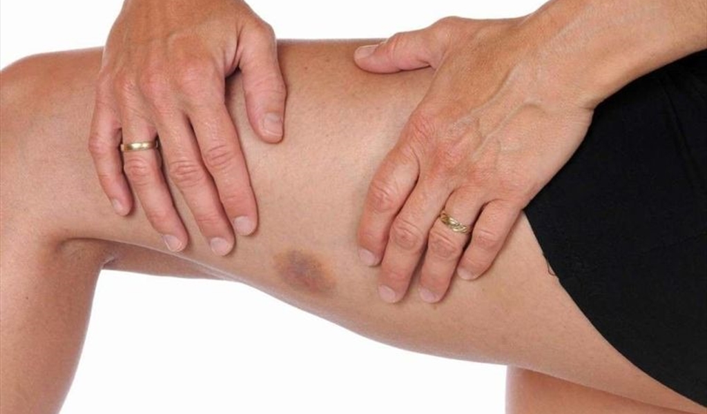 أسباب وعلاج ظهور الكدمات في الجسم
