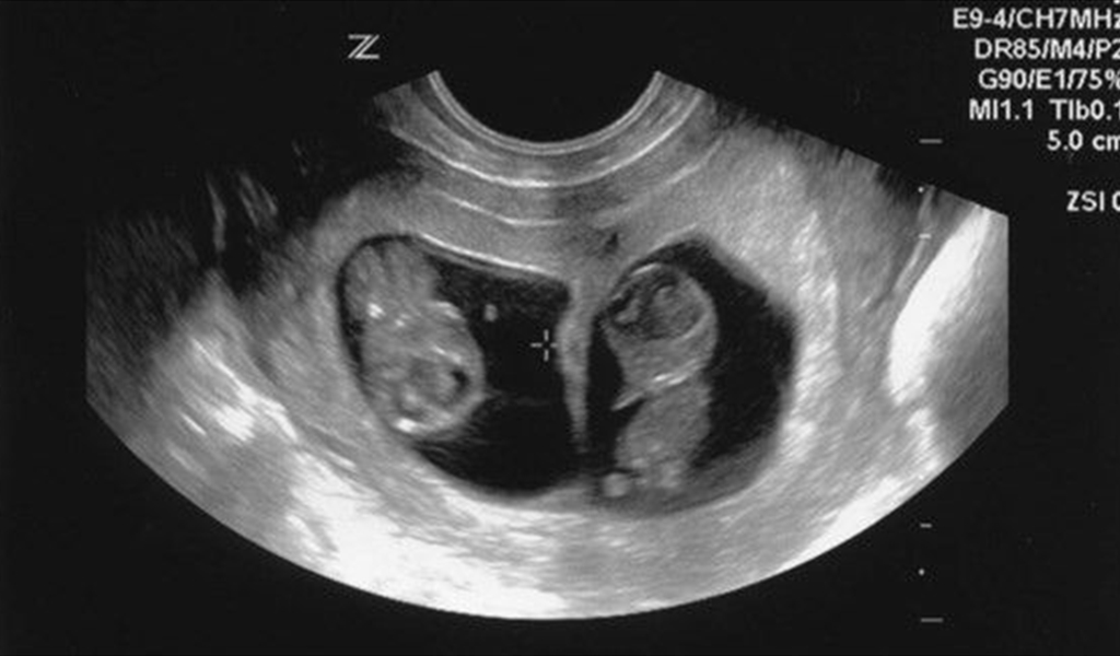 متى تظهر علامات الحمل بتوأم؟