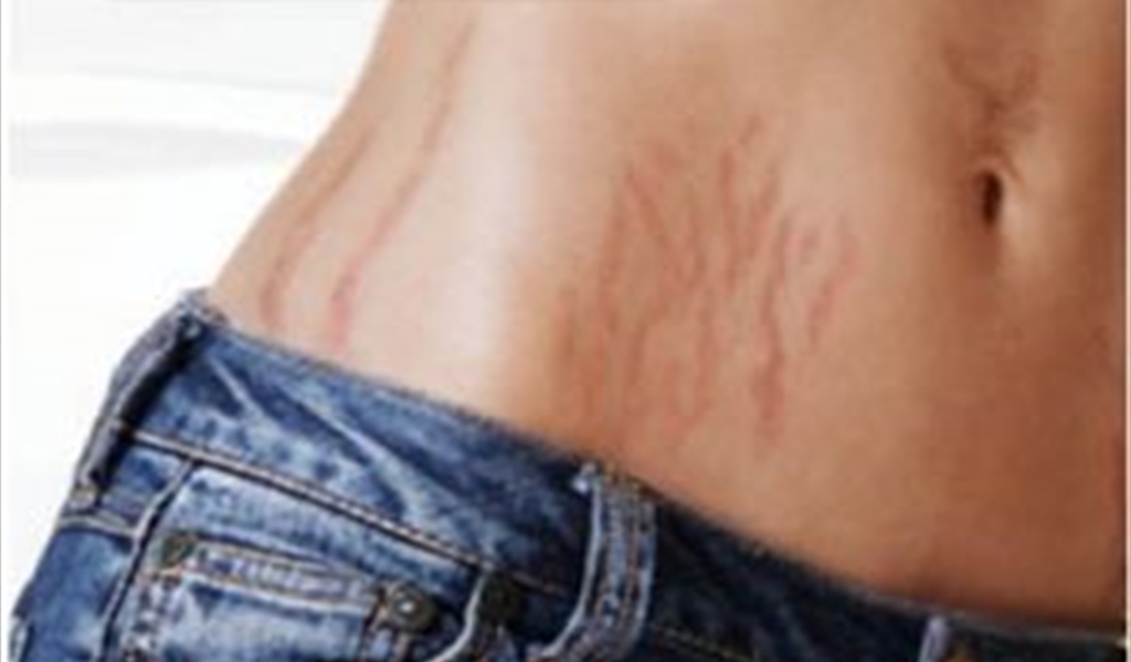 ما هو الفرق بين علامات التمدد الحمراء والبيضاء، وطرق علاجها؟