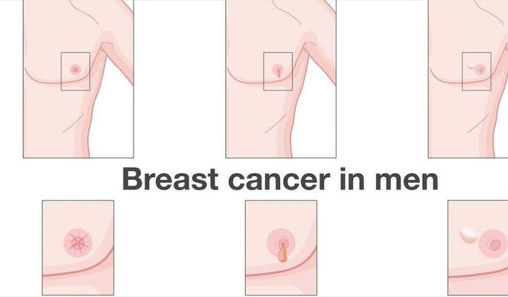 سرطان الثدي عند الرجال له ٨ علامات .. هذه هي!