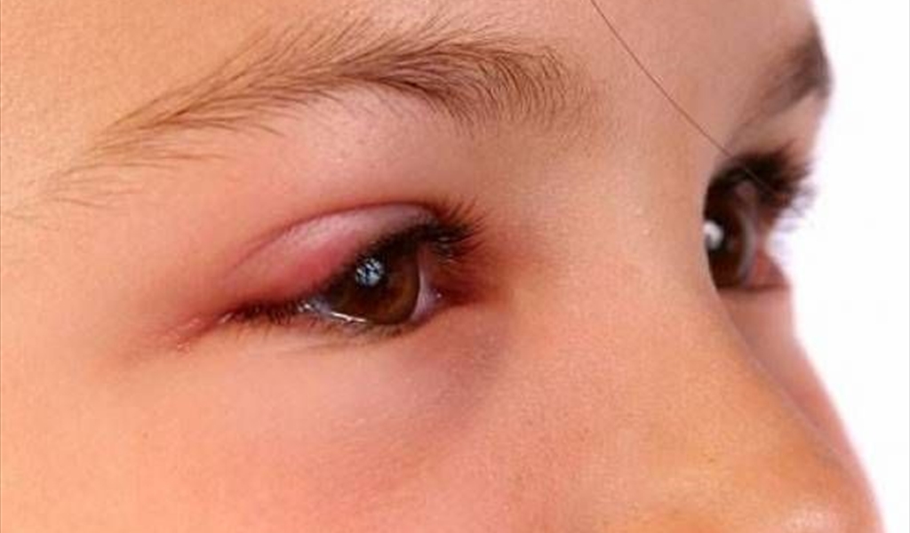 إلتهاب "ملتحمة العين" .. أنواعه وأعراضه وعلاجه