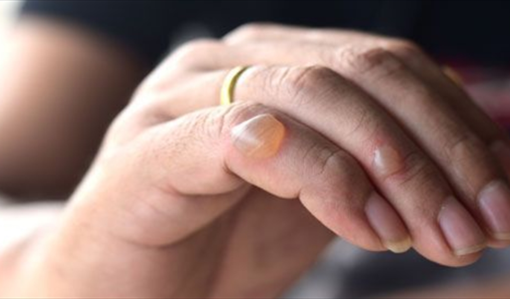 هل تعانون من ظهور فقاعات مائية على الجلد؟ اليكم طرق علاجها