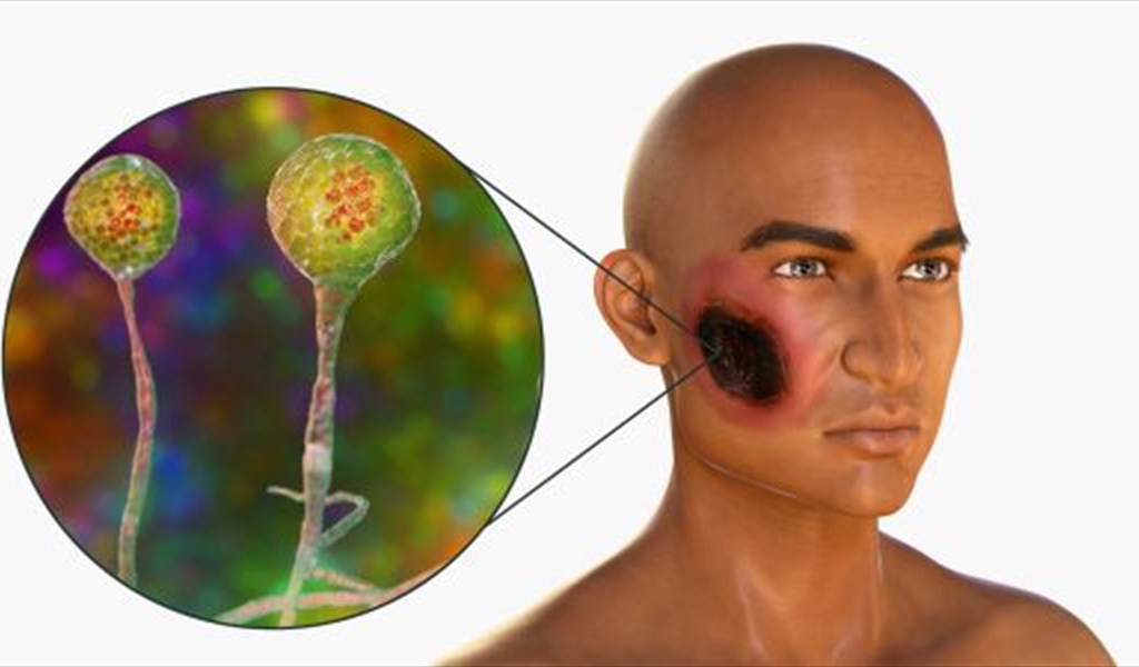 أعراض الفطر الأسود.. 18 علامة على الإصابة بالمرض