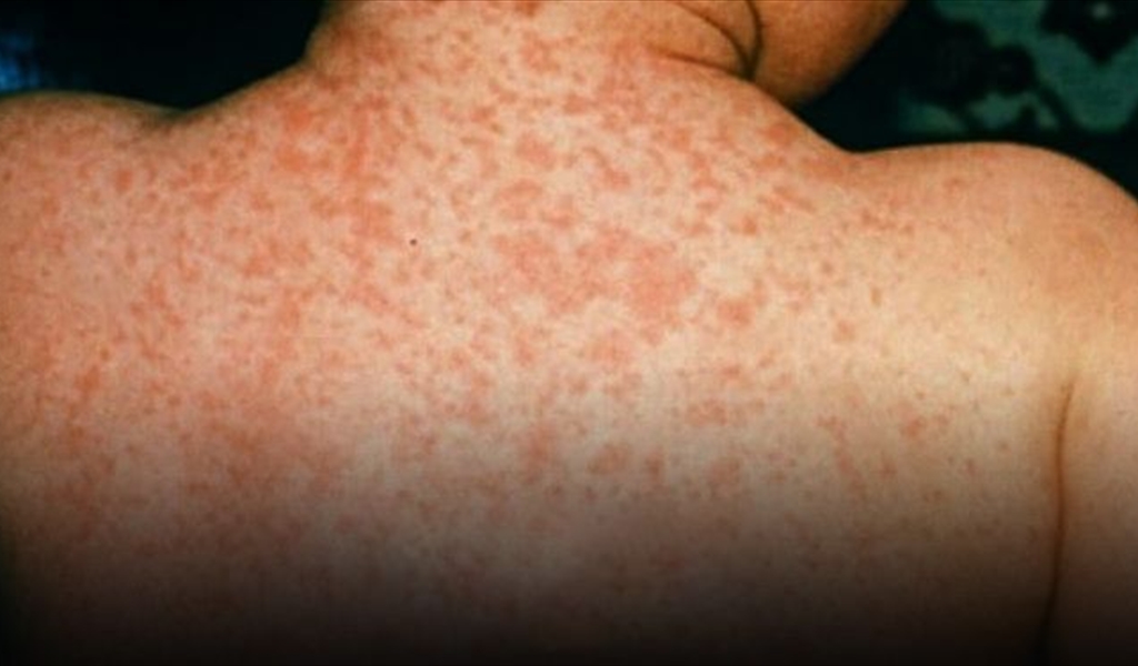 كل ما تريد معرفته عن التهاب السحايا