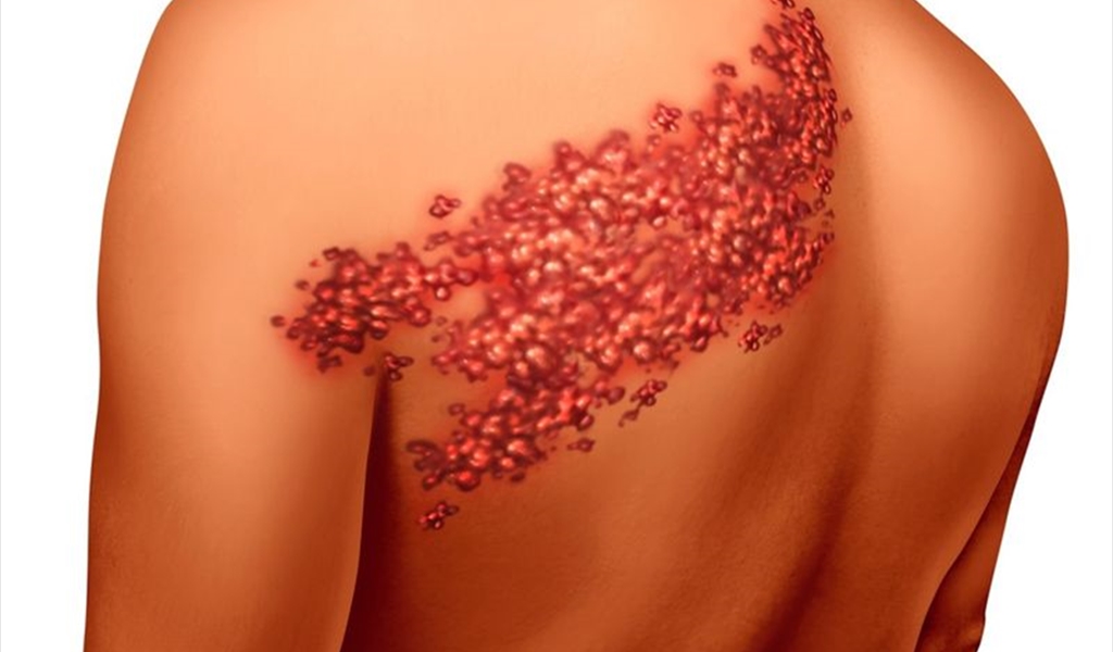 أسباب الإصابة بالحزام الناري