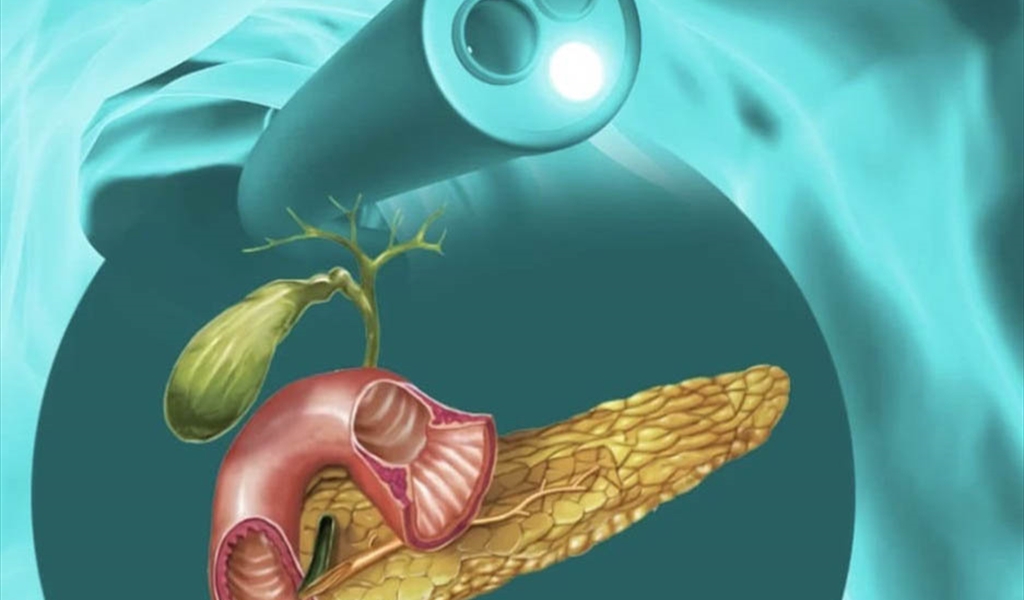 إلتهاب البنكرياس قد يؤدي لمضاعفات خطيرة