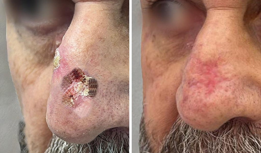 سرطان الجلد: تهديد يتعدَّى الشمس إلى المياه الملوَّثة وجلسات السولاريوم