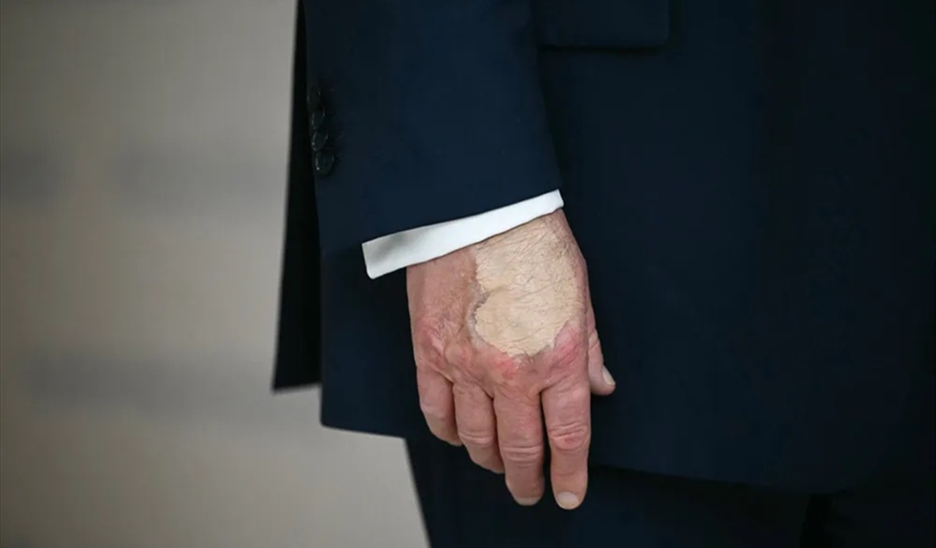 كدمة ومكياج على يد ترامب… ما القصة!؟