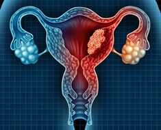 سرطان عنق الرحم أكثر أنواع السرطانات شيوعاً