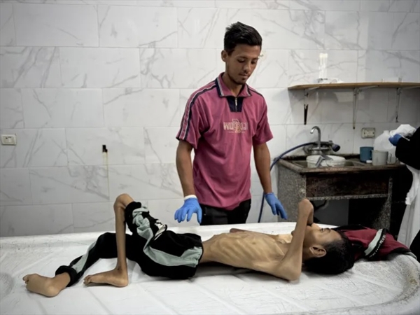 الجوع يفتك بأطفال غزة والعالم يتفرَّج