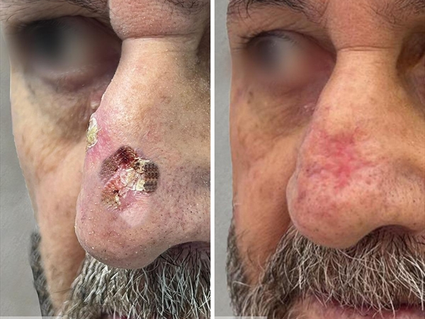 سرطان الجلد: تهديد يتعدَّى الشمس إلى المياه الملوَّثة وجلسات السولاريوم