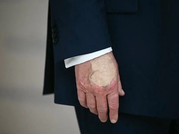 كدمة ومكياج على يد ترامب… ما القصة!؟