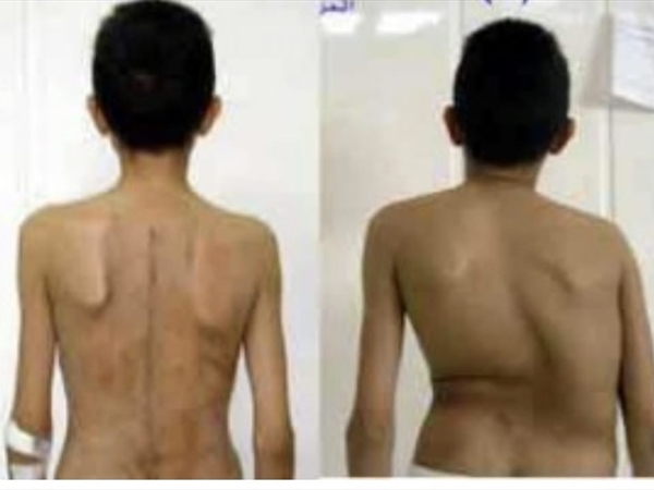 ماذا تعلم عن مرض الجنف؟